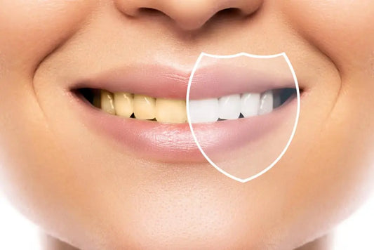 PAP — La revolución del blanqueamiento dental sin peróxido